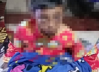Anak Kelas 3 SD 17 Ganet Dipukul Ayah Tiri hingga Babak Belur